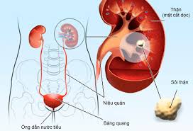Bệnh Sỏi Thận Không Nên Ăn Gì?