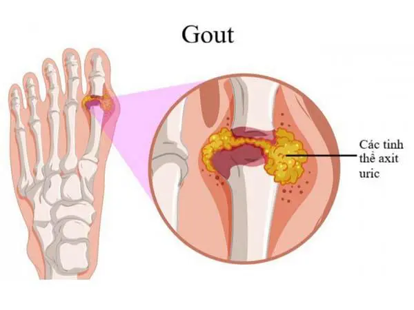 Tại sao nói Axit uric tăng cao gây bệnh gút là không thể xem thường?