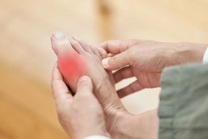 Vì sao mùa hè dễ tái phát cơn đau gout cấp