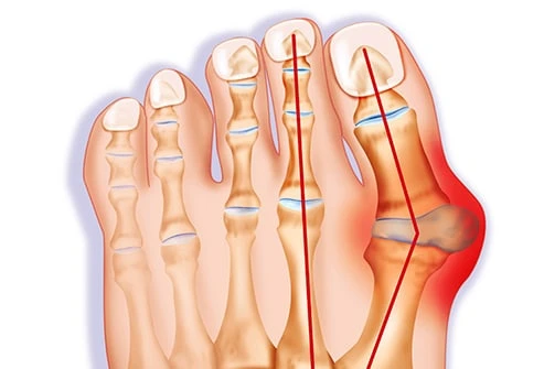 Biến dạng ngón chân cái: triệu chứng, nguyên nhân và phương pháp điều trị
