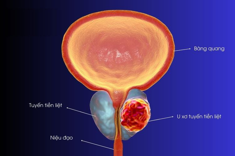 10 loại thảo dược tốt cho phì đại tiền liệt tuyến