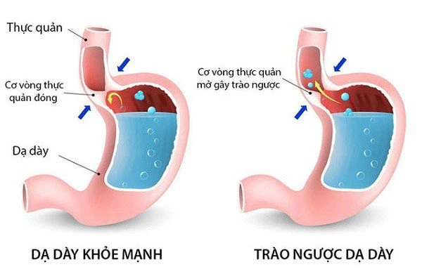 Barrett thực quản: Chẩn đoán và điều trị