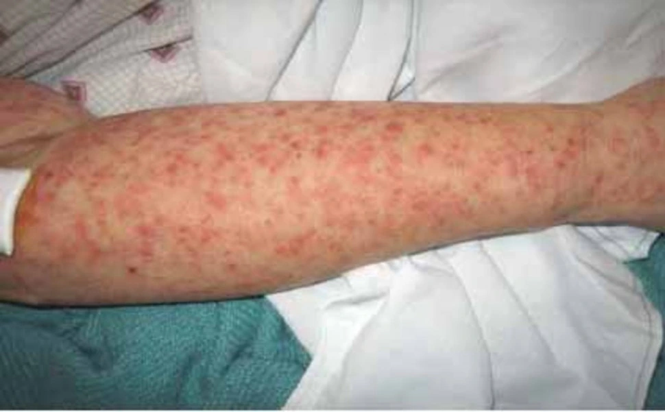 Bệnh Chikungunya: Nguyên nhân, triệu chứng và cách phòng ngừa hiệu quả