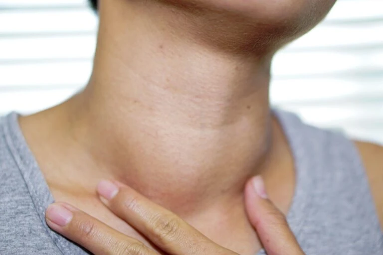 Bệnh bướu cổ: Nguyên nhân, triệu chứng và cách điều trị
