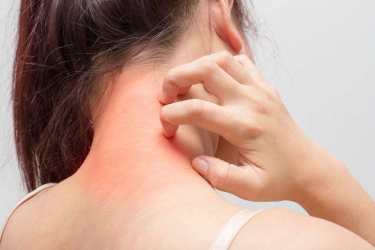 Bệnh dị ứng là gì? Triệu chứng, nguyên nhân và cách điều trị bệnh dị ứng