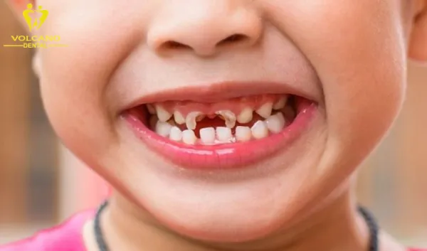  Trẻ bị sún răng, ba mẹ nên làm gì?