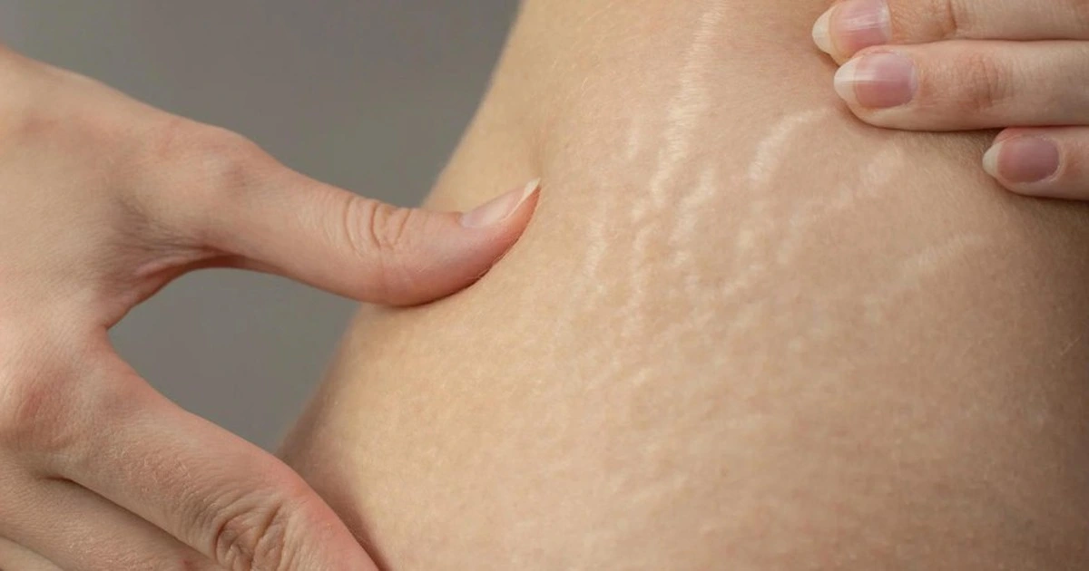 Rạn da đỏ, rạn da trắng là gì? 3 cách trị rạn da hiệu quả