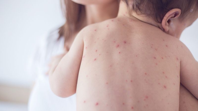 Cách điều trị và chăm sóc trẻ nhiễm sốt xuất huyết tại nhà