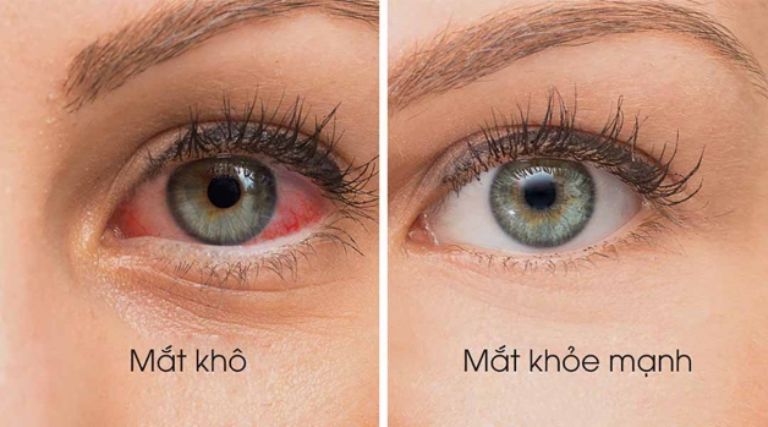 Cách chữa khô mắt tại nhà hiệu quả cho dân văn phòng