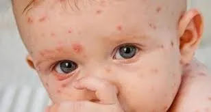Số ca mắc sởi tại Hà Nội tăng