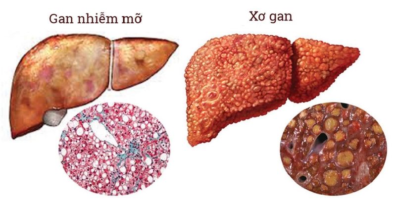 Gan nhiễm mỡ độ 1 và những điều cần biết