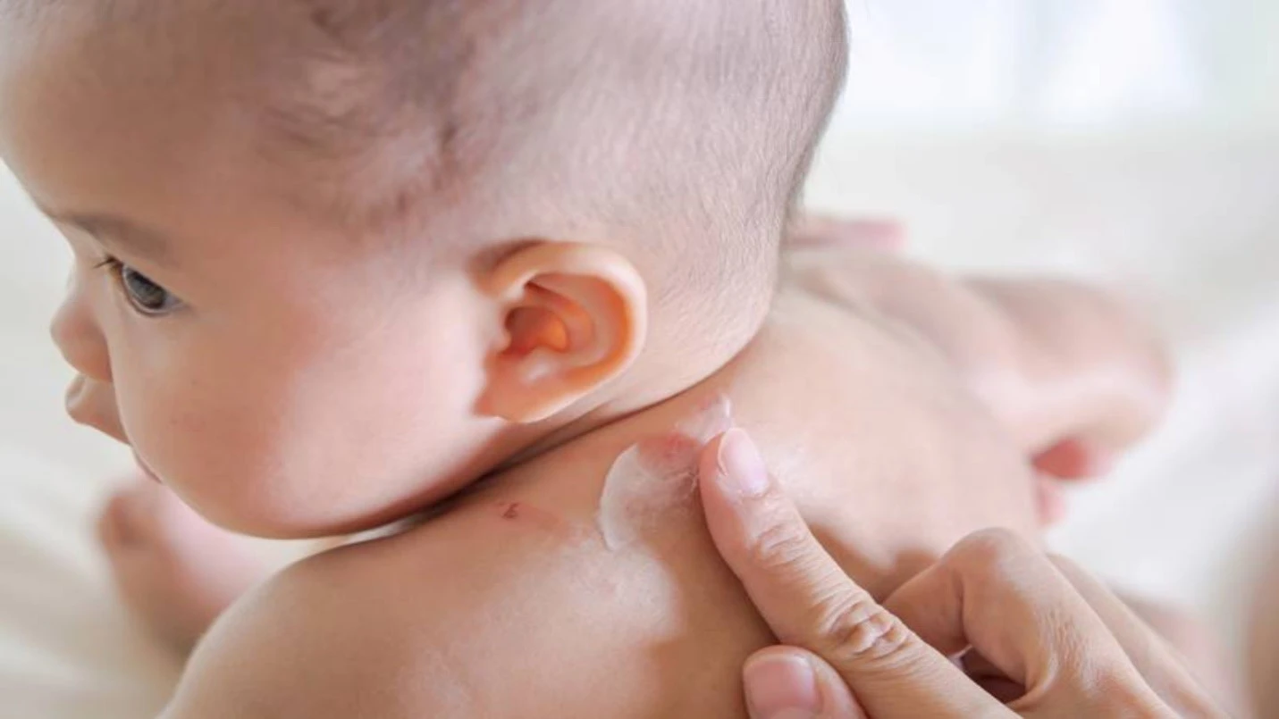 Các bệnh về da mùa hè thường gặp và cách phòng ngừa